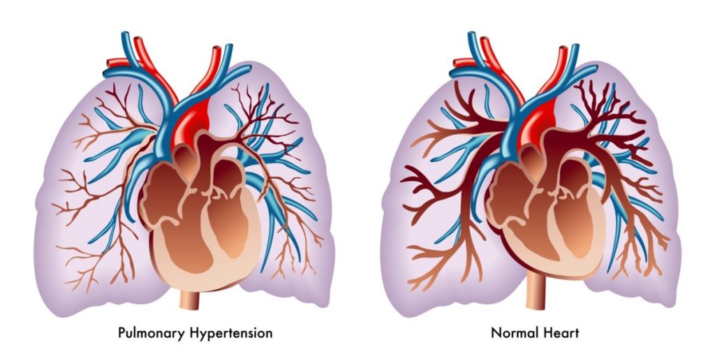 pulmonary arterial hypertension premier