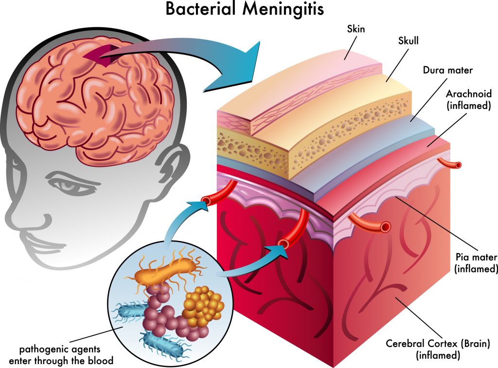meningitis bakteri yang dapat disembuhkan