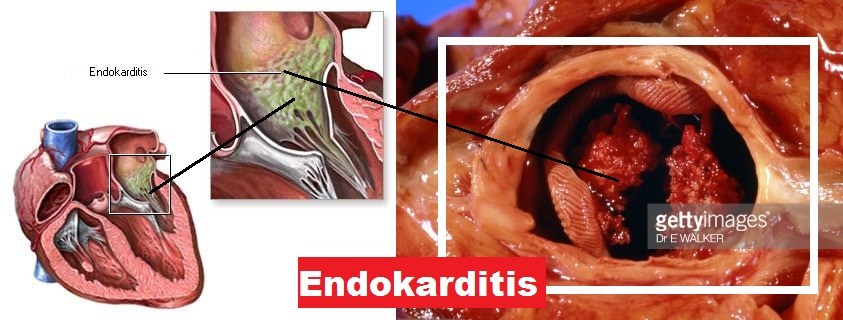 Penyakit Endokarditis Infektif