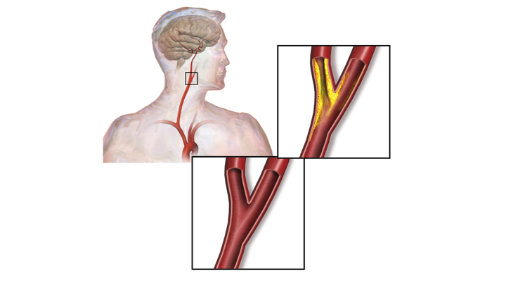 Operasi Arteri Carotid